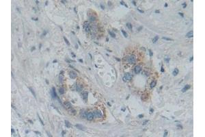 Detection of SMAD5 in Human Pancreatic cancer Tissue using Polyclonal Antibody to SMAD family member 5 (SMAD5) (SMAD5 antibody  (AA 210-464))