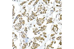 Immunohistochemistry of paraffin-embedded human breast cancer using Lamin A/C Rabbit pAb (ABIN6133798 and ABIN6143078) at dilution of 1:150 (40x lens). (Lamin A/C antibody)