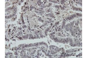 Immunoperoxidase of monoclonal antibody to FOXO3A on formalin-fixed paraffin-embedded human colon adenocarcinoma. (FOXO3 antibody  (AA 361-460))