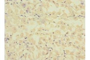 Immunohistochemistry of paraffin-embedded human gastric cancer using ABIN7152656 at dilution of 1:100 (FCRL2 antibody  (AA 20-100))