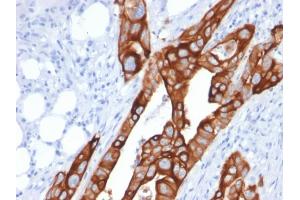 Formalin-fixed, paraffin-embedded human Colon Carcinoma stained with Cytokeratin 20 (KRT20) Mouse Monoclonal Antibody (KRT20/1991). (KRT20 antibody  (AA 196-323))
