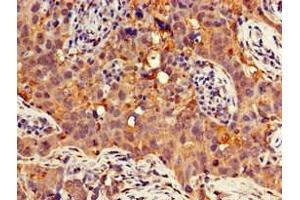 Immunohistochemistry of paraffin-embedded human pancreatic cancer using ABIN7154741 at dilution of 1:100 (GNB4 antibody  (AA 105-185))