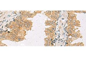 Immunohistochemistry of paraffin-embedded Human prost ate cancer tissue using SLC30A6 Polyclonal Antibody at dilution of 1:70(x200) (SLC30A6 antibody)