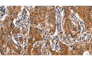 Immunohistochemistry of paraffin-embedded Human gastic cancer using BGN Polyclonal Antibody at dilution of 1:50 (Biglycan antibody)