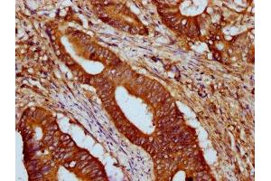 IHC image of ABIN7164031 diluted at 1:500 and staining in paraffin-embedded human colon cancer performed on a Leica BondTM system. (HCN1 antibody  (AA 784-887))