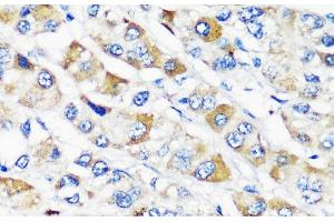 Immunohistochemistry of paraffin-embedded Human liver cancer using TSC2 Polyclonal Antibody at dilution of 1:200 (40x lens). (Tuberin antibody)
