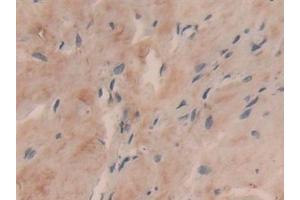 Detection of COL6a3 in Human Breast cancer Tissue using Polyclonal Antibody to Collagen Type VI Alpha 3 (COL6a3)