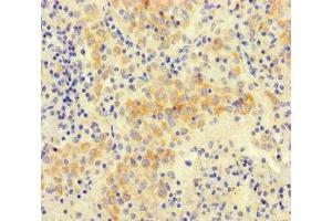 Immunohistochemistry of paraffin-embedded human lung cancer using ABIN7161144 at dilution of 1:100 (NEO1 antibody  (AA 414-682))