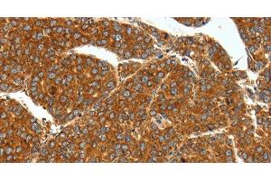 Immunohistochemistry of paraffin-embedded Human liver cancer using SSTR1 Polyclonal Antibody at dilution of 1:40 (SSTR1 antibody)