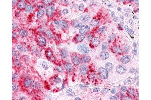 Anti-ESRRA / ERR Alpha antibody IHC of human Lung, Non-Small Cell Carcinoma. (ESRRA antibody  (Ligand Binding Domain))