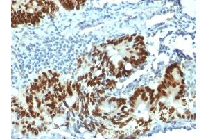 Formalin-fixed, paraffin-embedded human Colon Carcinoma stained with p53 Mouse Monoclonal Antibody (PAb1801). (p53 antibody)
