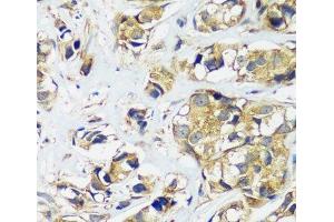 Immunohistochemistry of paraffin-embedded Human breast cancer using CCDC124 Polyclonal Antibody at dilution of 1:100 (40x lens). (CCDC124 antibody)