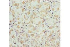 Immunohistochemistry of paraffin-embedded human gastric cancer using ABIN7168446 at dilution of 1:100 (ROBO3 antibody  (AA 1237-1386))