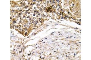 Immunohistochemistry of paraffin-embedded Human breast cancer using ARRB2 Polyclonal Antibody at dilution of 1:200 (40x lens). (Arrestin 3 antibody)