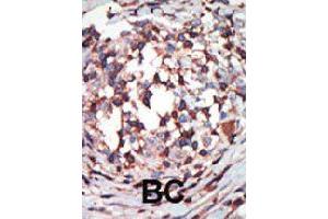 Formalin-fixed and paraffin-embedded human cancer tissue reacted with PRKCB polyclonal antibody  , which was peroxidase-conjugated to the secondary antibody, followed by AEC staining . (PKC beta antibody  (C-Term))