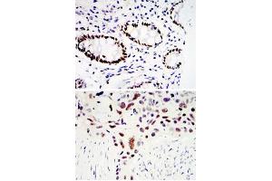 Immunohistochemical analysis of paraffin-embedded human colon cancer tissues (upper) and lung cancer tissues (bottom) using KLF4 monoclonal antibody, clone 1E6  with DAB staining. (KLF4 antibody)