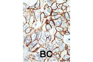 Purified rabbit HDAC11 polyclonal antibody  was used in immunohistochemistry on human breast carcinoma. (HDAC11 antibody  (C-Term))