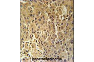 DHB13 Antibody immunohistochemistry analysis in formalin fixed and paraffin embedded human hepatocarcinoma followed by peroxidase conjugation of the secondary antibody and DAB staining. (HSD17B13 antibody  (N-Term))