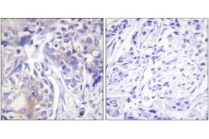 Immunohistochemistry analysis of paraffin-embedded human breast carcinoma tissue, using ADD1 (Ab-445) Antibody. (alpha Adducin antibody  (AA 411-460))