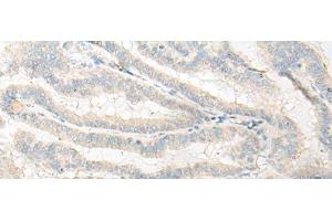 Immunohistochemistry of paraffin-embedded Human thyroid cancer tissue using DNASE1L1 Polyclonal Antibody at dilution of 1:25(x200) (DNASEX antibody)