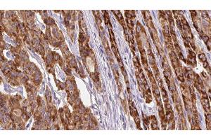 ABIN6267139 at 1/100 staining Human thyroid cancer tissue by IHC-P. (MFF antibody  (pSer172))