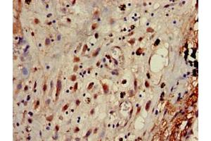 Immunohistochemistry of paraffin-embedded human lung cancer using ABIN7144346 at dilution of 1:100 (gamma 1 Adaptin antibody  (AA 592-686))
