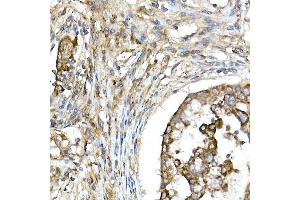 Immunohistochemistry of paraffin-embedded human lung cancer using TNF Rabbit pAb (ABIN3022984, ABIN3022985, ABIN3022986 and ABIN6219332) at dilution of 1:50 (40x lens). (TNFAIP3 antibody  (AA 1-190))