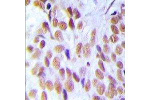 Immunohistochemical analysis of HMGB1 staining in human breast cancer formalin fixed paraffin embedded tissue section. (HMGB1 antibody)
