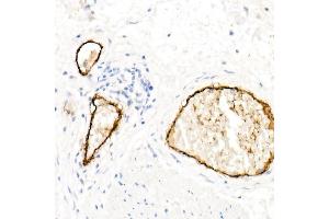 Immunohistochemistry of paraffin-embedded Human esophageal cancer using von Willebrand factor (VWF) antibody (ABIN7271339) at dilution of 1:800 (40x lens). (VWF antibody)