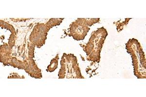 Immunohistochemistry of paraffin-embedded Human thyroid cancer tissue using ZBTB43 Polyclonal Antibody at dilution of 1:40(x200) (ZBTB43 antibody)