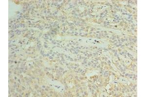 Immunohistochemistry of paraffin-embedded human breast cancer using ABIN7170641 at dilution of 1:100 (RBM11 antibody  (AA 115-278))
