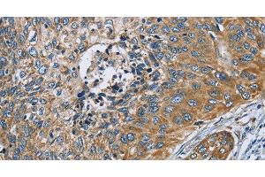 Immunohistochemistry of paraffin-embedded Human cervical cancer tissue using ZMYND11 Polyclonal Antibody at dilution 1:70 (ZMYND11 antibody)