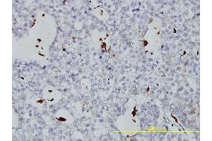 Immunoperoxidase of monoclonal antibody to PLTP on formalin-fixed paraffin-embedded human ovary, clear cell carcinoma tissue. (PLTP antibody  (AA 19-441))