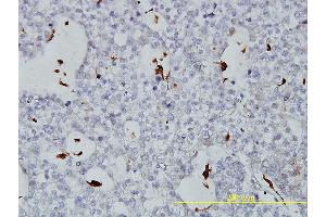 Immunoperoxidase of monoclonal antibody to PLTP on formalin-fixed paraffin-embedded human ovary, clear cell carcinoma tissue.