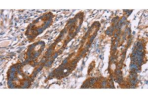Immunohistochemistry of paraffin-embedded Human colon cancer using CLP36 Polyclonal Antibody at dilution of 1:30 (PDLIM1 antibody)