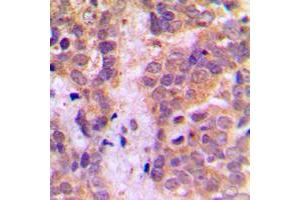 Immunohistochemical analysis of Caspase 9 staining in human breast cancer formalin fixed paraffin embedded tissue section. (Caspase 9 antibody  (Center))