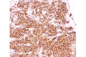 IHC-P: p50 antibody testing of human lung cancer tissue (CD40 antibody  (AA 1-360))