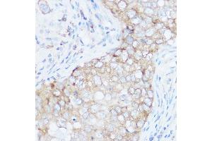 Immunohistochemistry of paraffin-embedded human breast cancer using EIF4G1 Rabbit pAb (ABIN6134646, ABIN6140092, ABIN6140093 and ABIN6221701) at dilution of 1:100 (40x lens). (EIF4G1 antibody  (AA 400-500))
