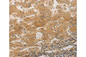 Immunohistochemistry of Human lung cancer using PPAP2A Polyclonal Antibody at dilution of 1:50 (PLPP1 antibody)