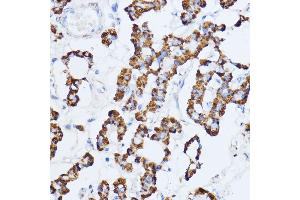 Immunohistochemistry of paraffin-embedded human thyroid cancer using Monoamine Oxidase A (Monoamine Oxidase A (MAOA)) antibody (ABIN3021915, ABIN3021916, ABIN3021917 and ABIN6217576) at dilution of 1:100 (40x lens).