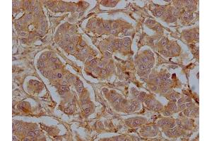 IHC image of ABIN7147203 diluted at 1:50 and staining in paraffin-embedded human breast cancer tissue performed on a Leica BondTM system.