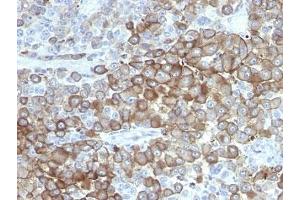 Formalin-fixed, paraffin-embedded human melanoma stained with Melanoma antibody. (Melanoma antibody)