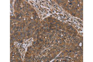 Immunohistochemistry of Human lung cancer using OXTR Polyclonal Antibody at dilution of 1:40