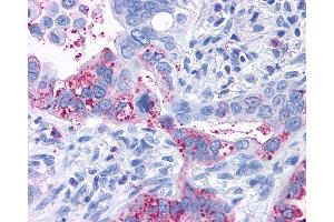 Anti-GPR6 antibody IHC of human Lung, Adenocarcinoma. (GPR6 antibody  (Cytoplasmic Domain))