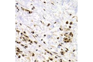 Immunohistochemistry of paraffin-embedded human kidney cancer using SUMO4 Antibody. (SUMO4 antibody)