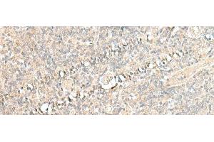 Immunohistochemistry of paraffin-embedded Human tonsil tissue using CALCOCO1 Polyclonal Antibody at dilution of 1:50(x200) (CALCOCO1 antibody)