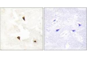 Immunohistochemistry analysis of paraffin-embedded human breast carcinoma tissue, using TP53I11 Antibody. (TP53I11 antibody  (AA 71-120))