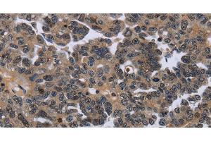 Immunohistochemistry of paraffin-embedded Human ovarian cancer using ITGAE Polyclonal Antibody at dilution of 1:50 (CD103 antibody)