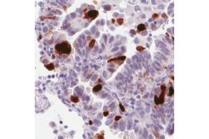 Immunohistochemical staining (Formalin-fixed paraffin-embedded sections) of human lung adenocarcinoma with ANLN monoclonal antibody, clone CL0301  shows strong nuclear immunoreactivity in a subset of tumor cells. (Anillin antibody)