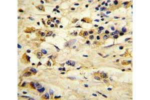 IHC analysis of FFPE human breast carcinoma stained with EIF4E2 antibody (EIF4E2 antibody)